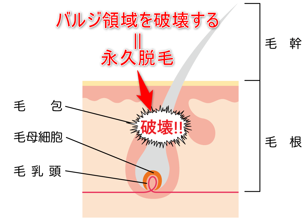 バルジ領域を破壊するということが永久脱毛ということを示した画像