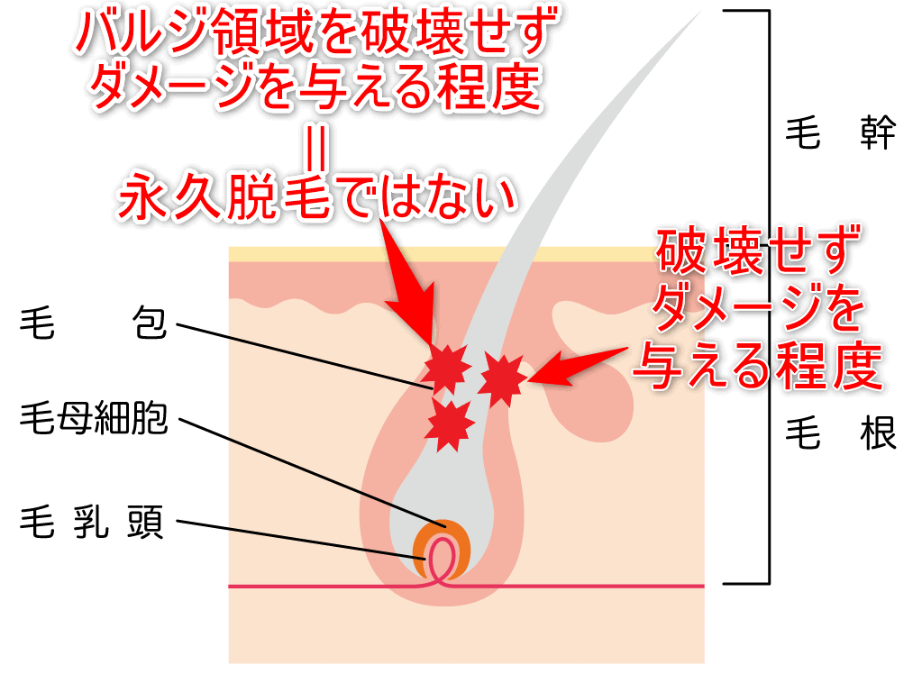 バルジ領域にダメージを与える程度では永久脱毛ではないことを示した画像