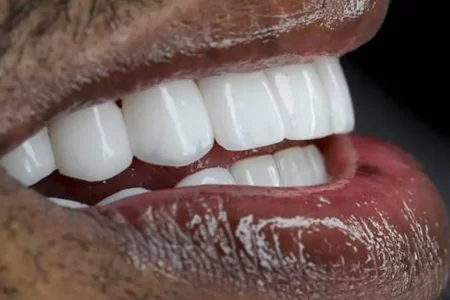Composite Resin Veneers on Smiling Patient
