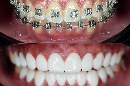 right veneer shade