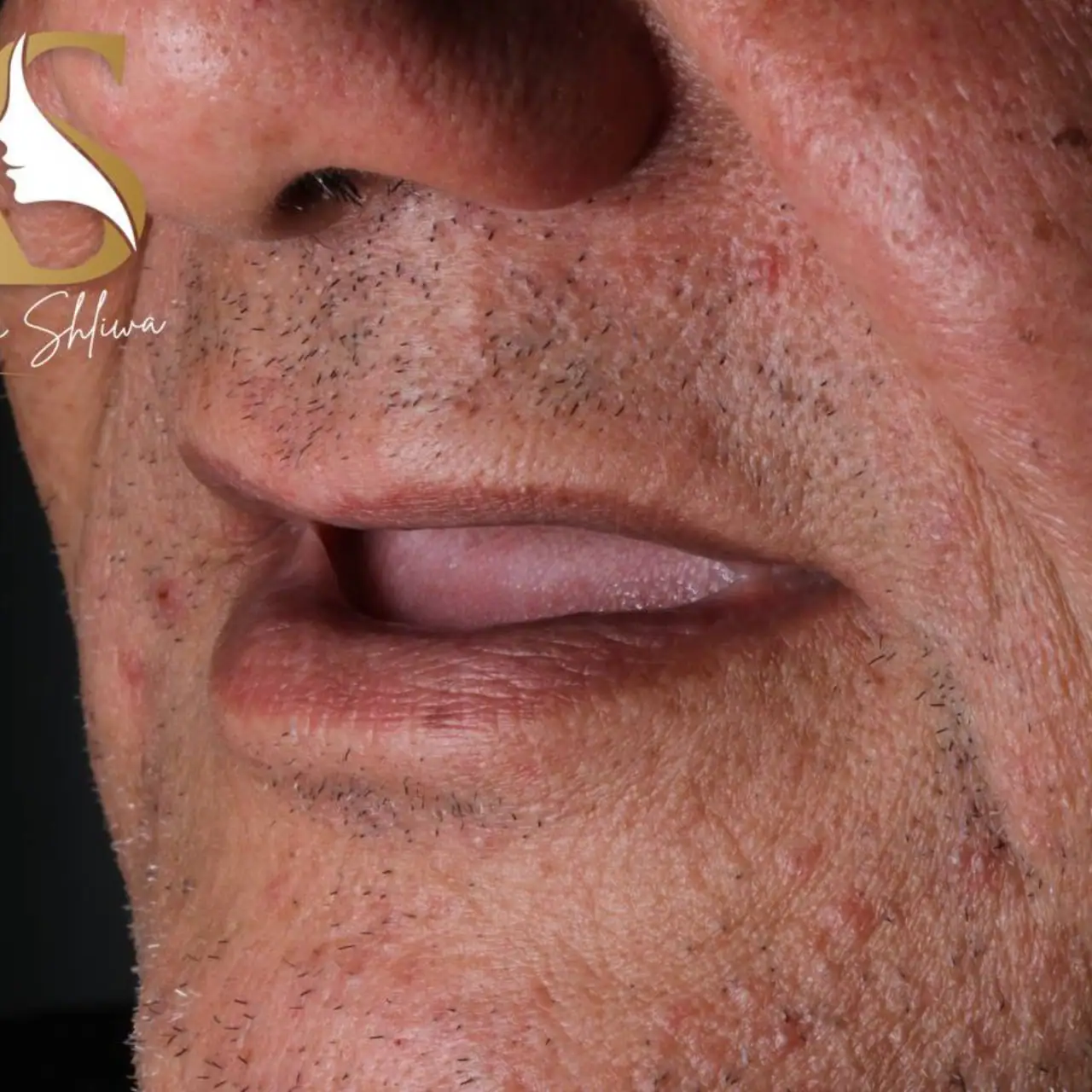 زراعة الاسنان