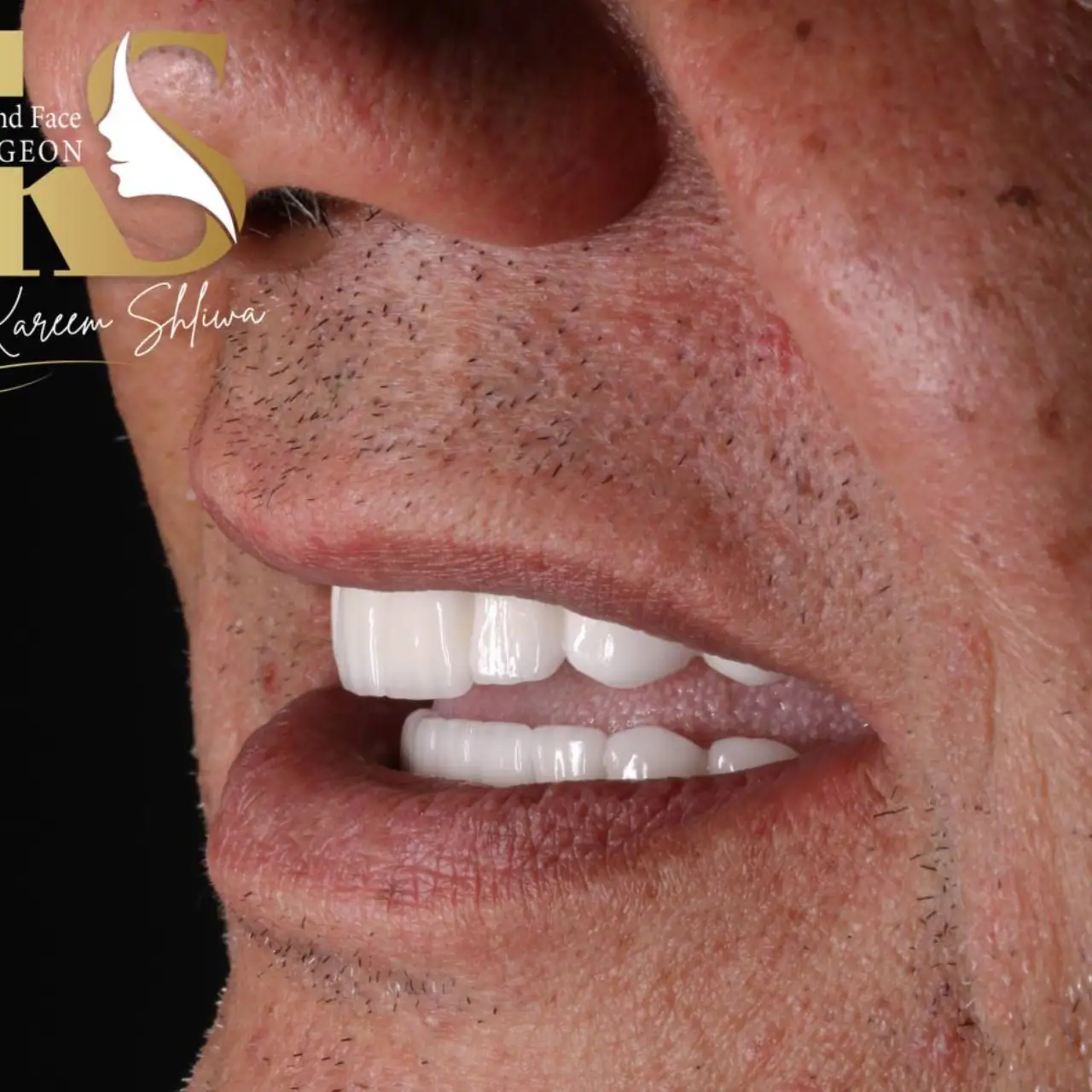 زراعة الأسنان