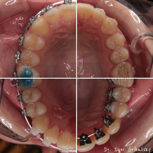 Metaliskas breketes keramiskas breketes lingvalas breketes caurspidigas kapes