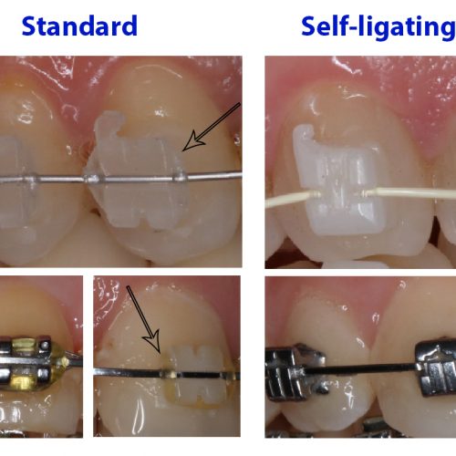 Metaliskas breketes keramiskas breketes lingvalas breketes