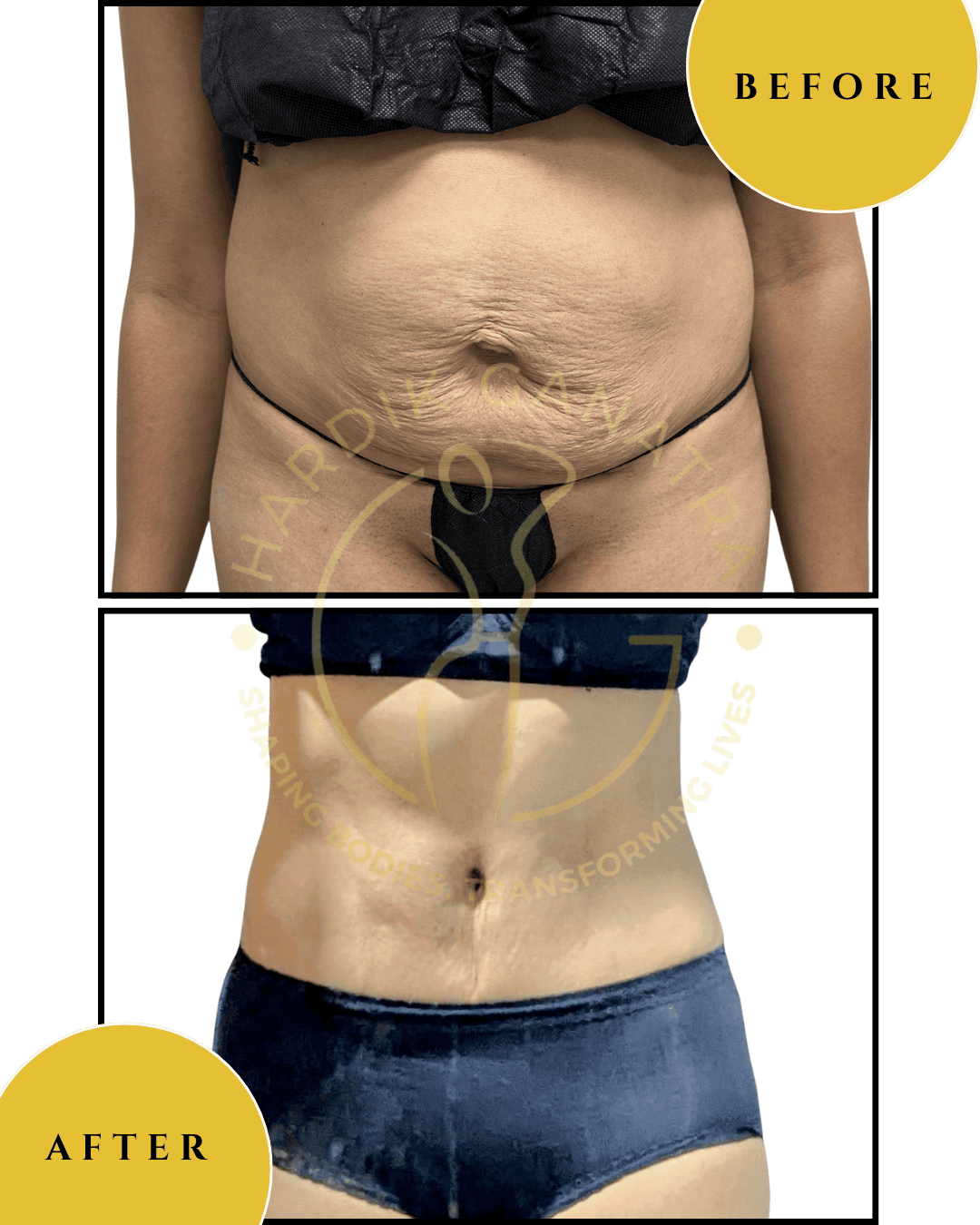Tummy tuck Diastasis Repair