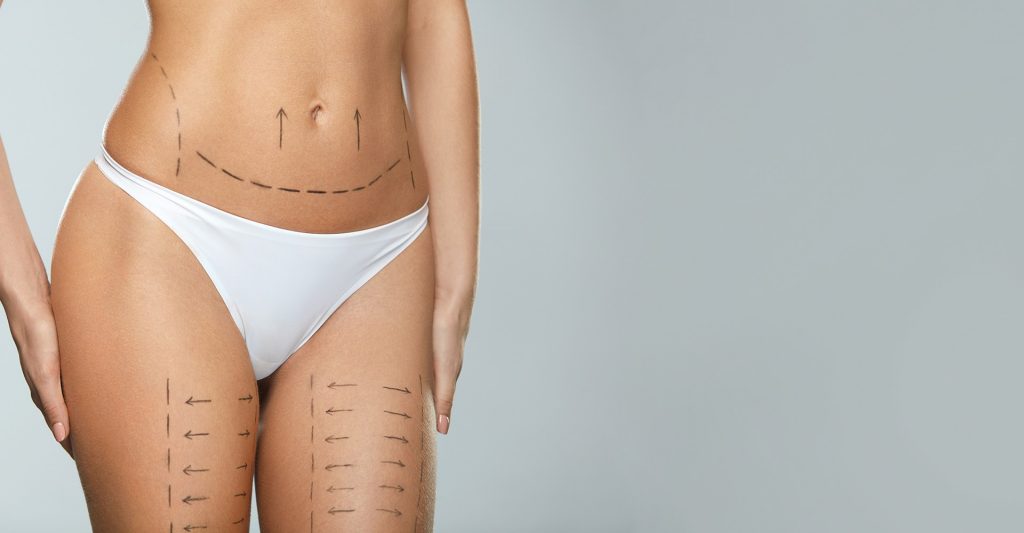 Liposuction
