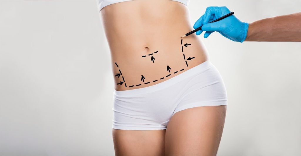 Tummy tuck
