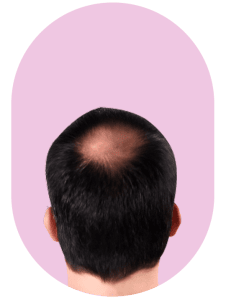 Hair Loss Treatment