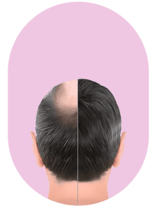 Hair Transplant