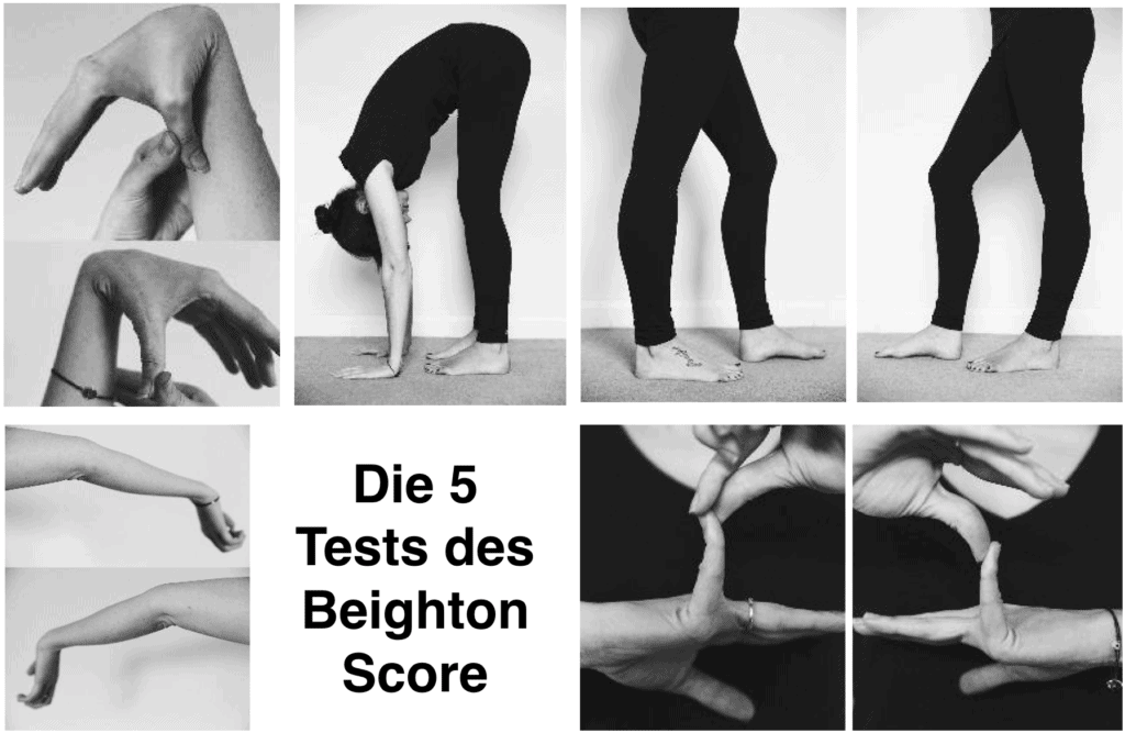 Beighton-Test