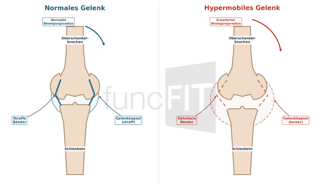 Infografik: Normales vs. hypermobiles Gelenk. Vergleich von Bändern und Gelenkkapsel bei Hypermobilität