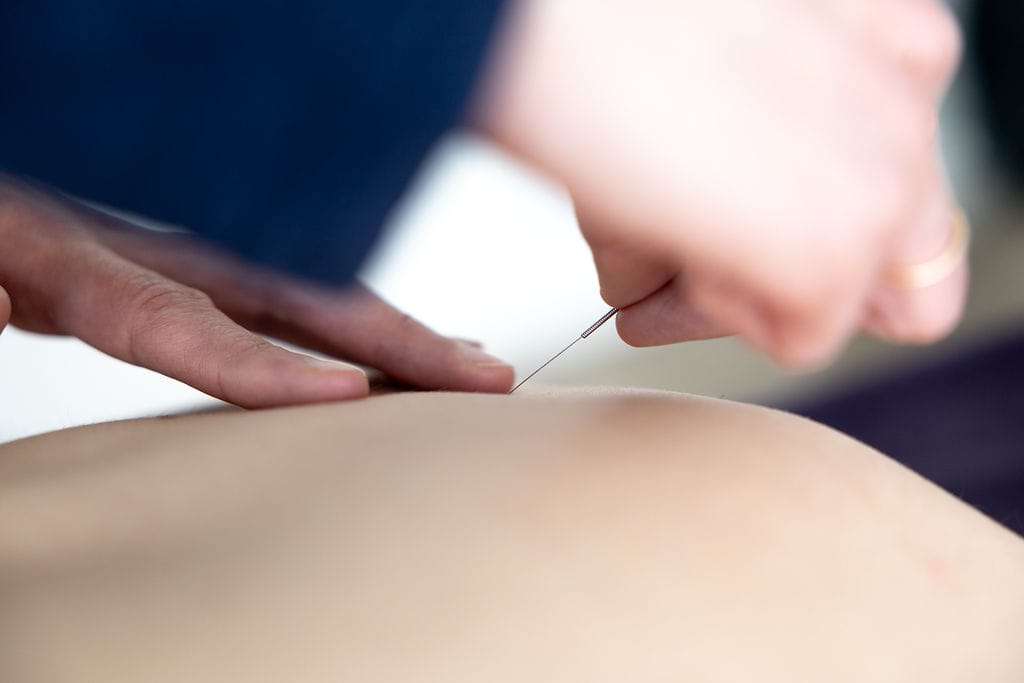 Dry needling behandeling bij Fysiotherapie Dunant in Roosendaal