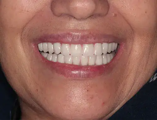 after dental implants