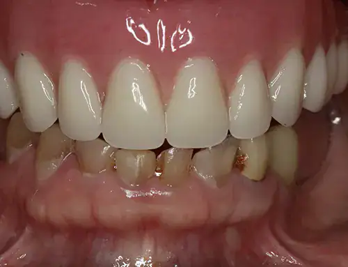 before dental implants