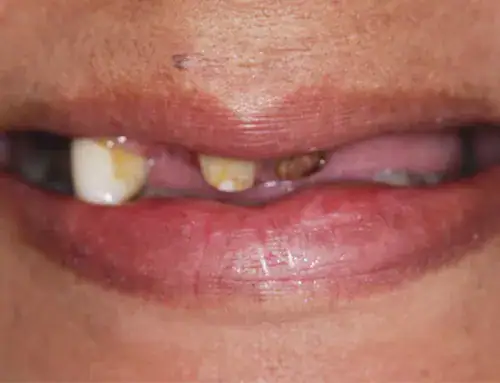 before dental implants