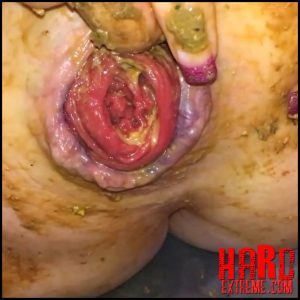 AutumnYoung – 16 mins DOUBLE FEATURE – TWO Prolapse Videos