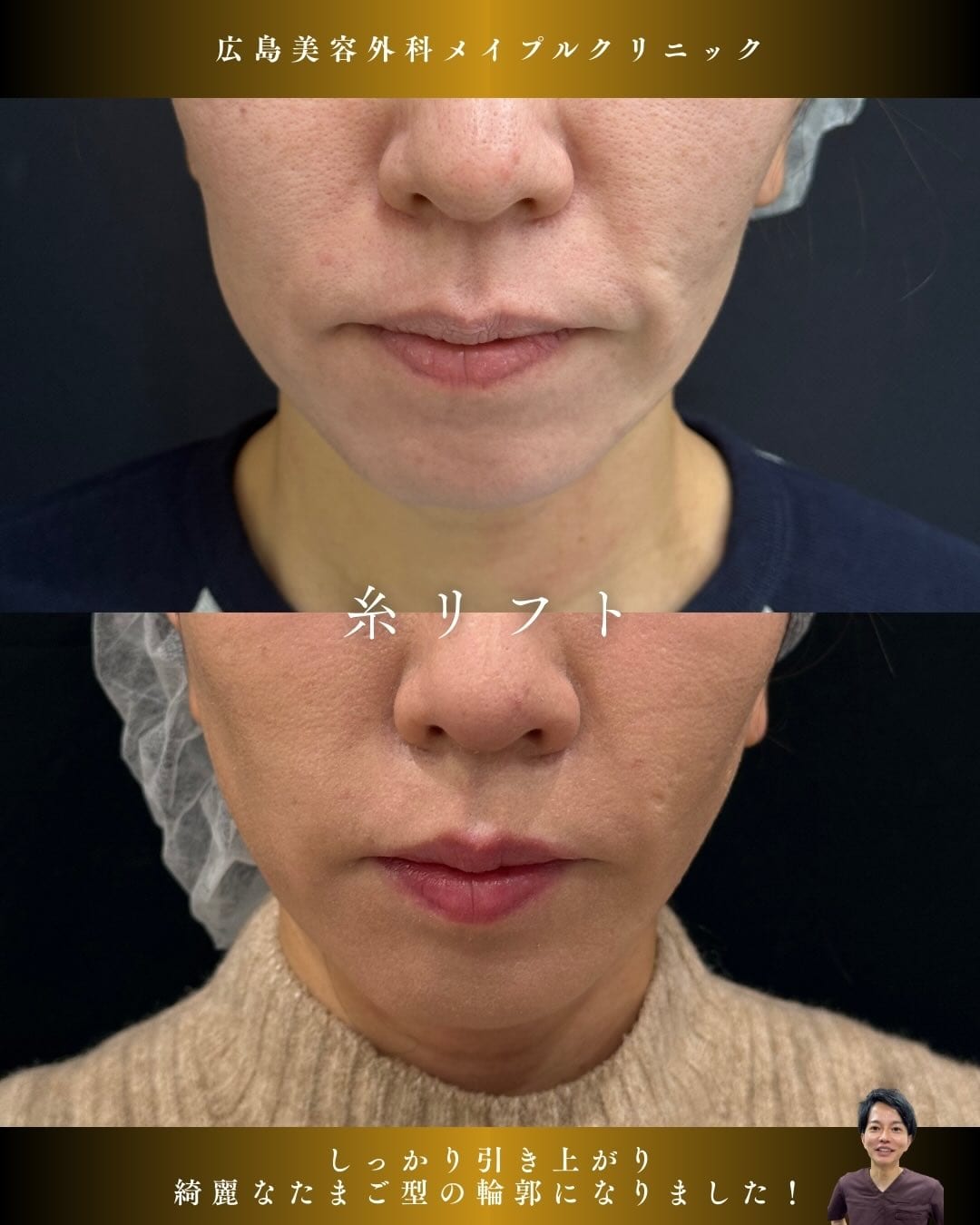 広島で人気の糸リフトのメイン画像