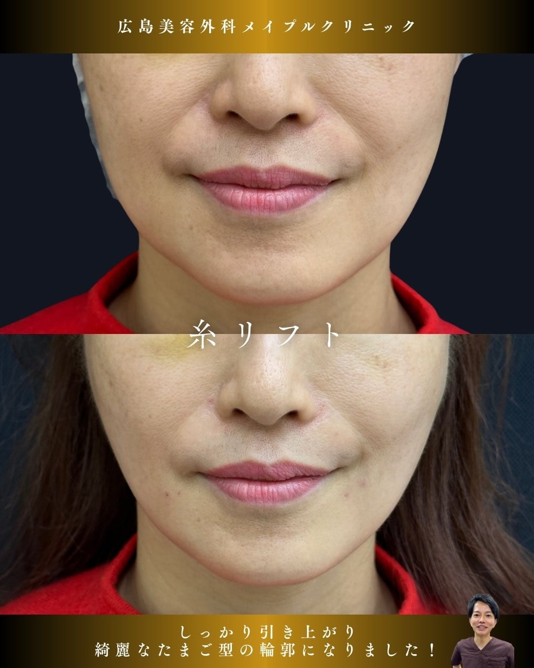 人気急上昇中の糸リフトのメイン画像