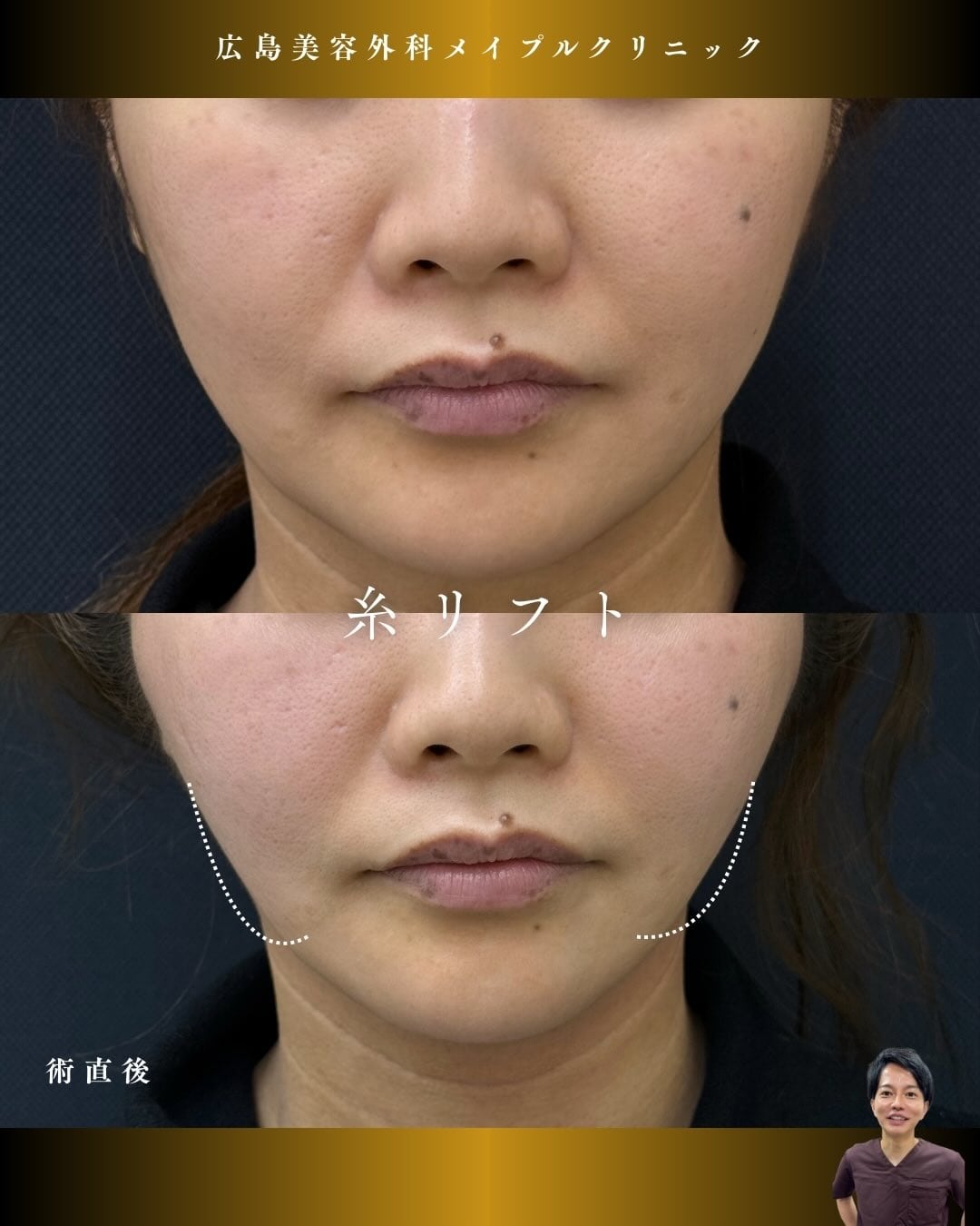 糸リフト&ほうれい線にヒアルロン酸注入のメイン画像