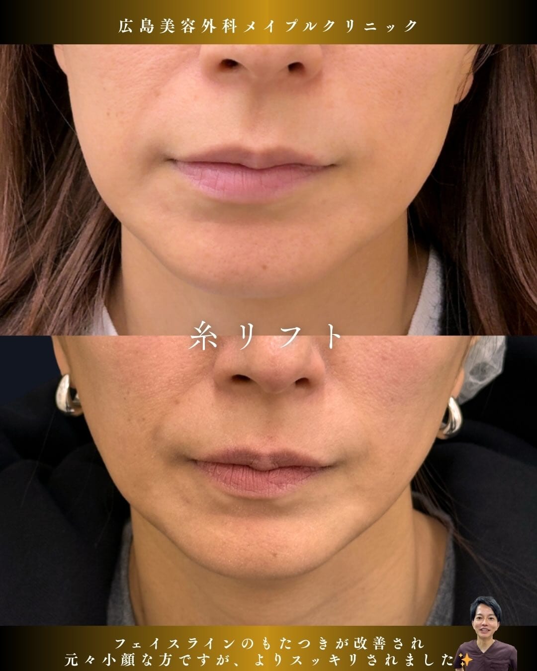 糸リフトでスッキリフェイスラインのメイン画像