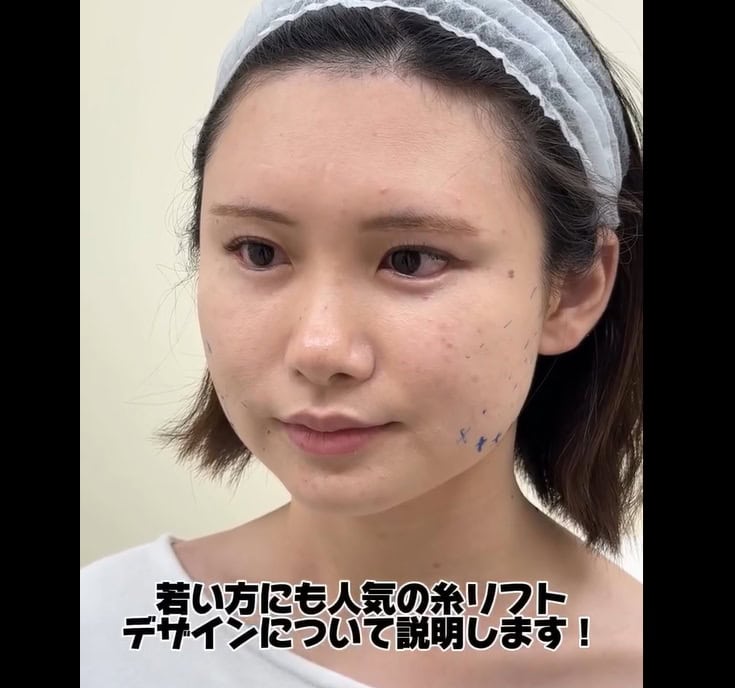 人気の糸リフトデザインについてのメイン画像