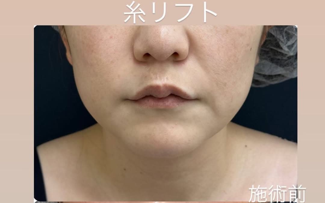 アンチエイジング効果のある糸リフトのメイン画像
