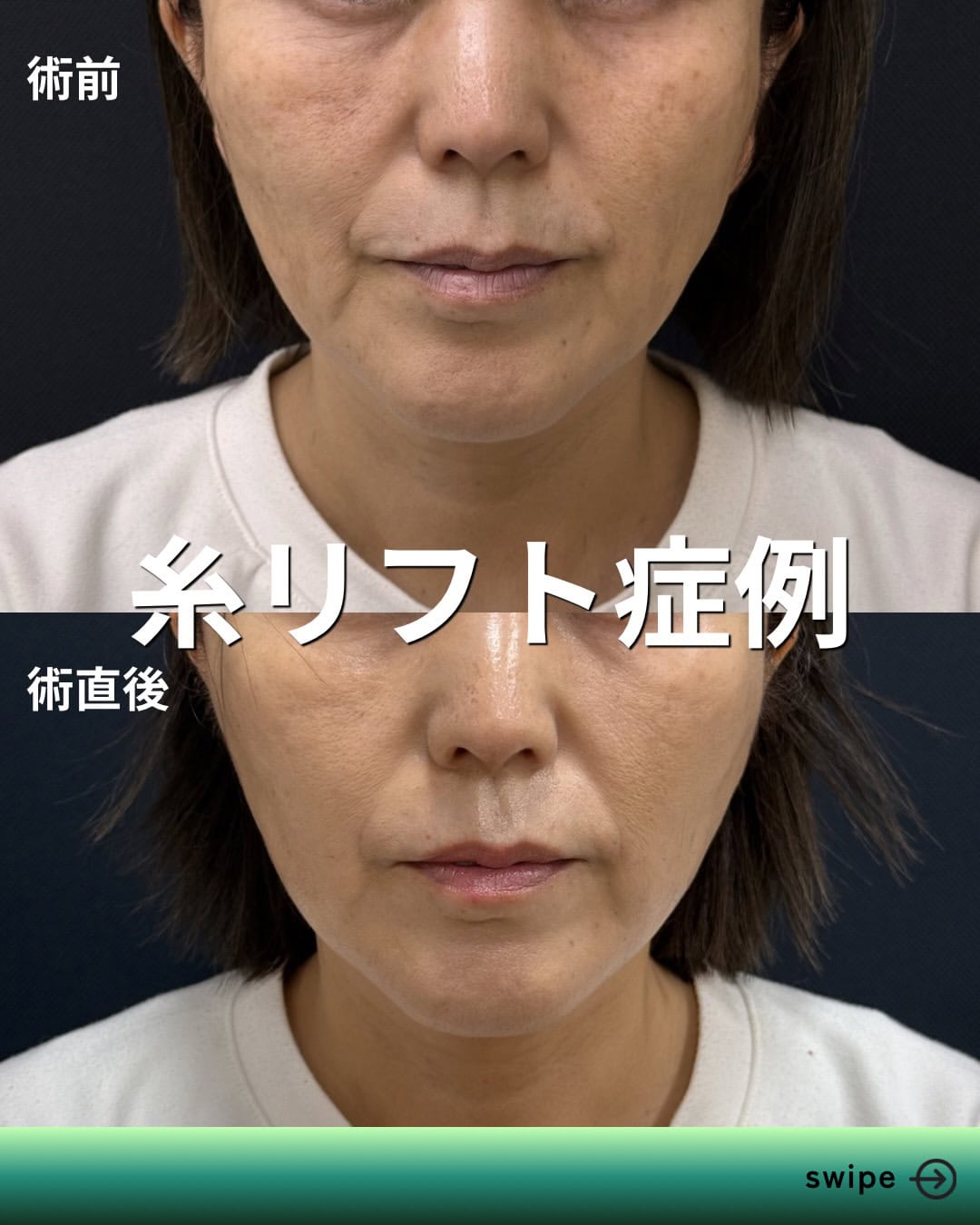 フェイスラインのもたつきには糸リフトのメイン画像
