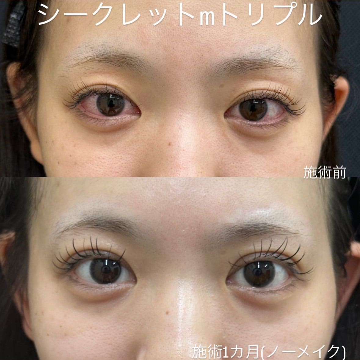 埋没法：医療用の糸で二重瞼を形成のメイン画像