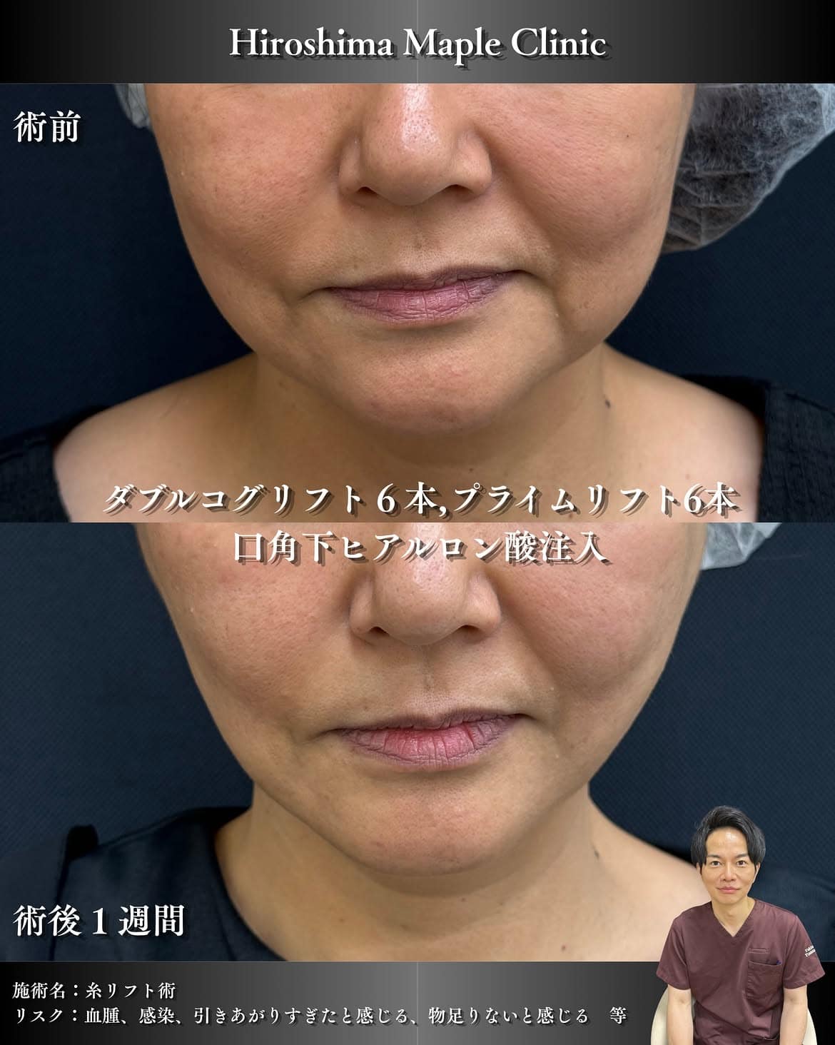 糸リフト × 口角下ヒアルロン酸のメイン画像
