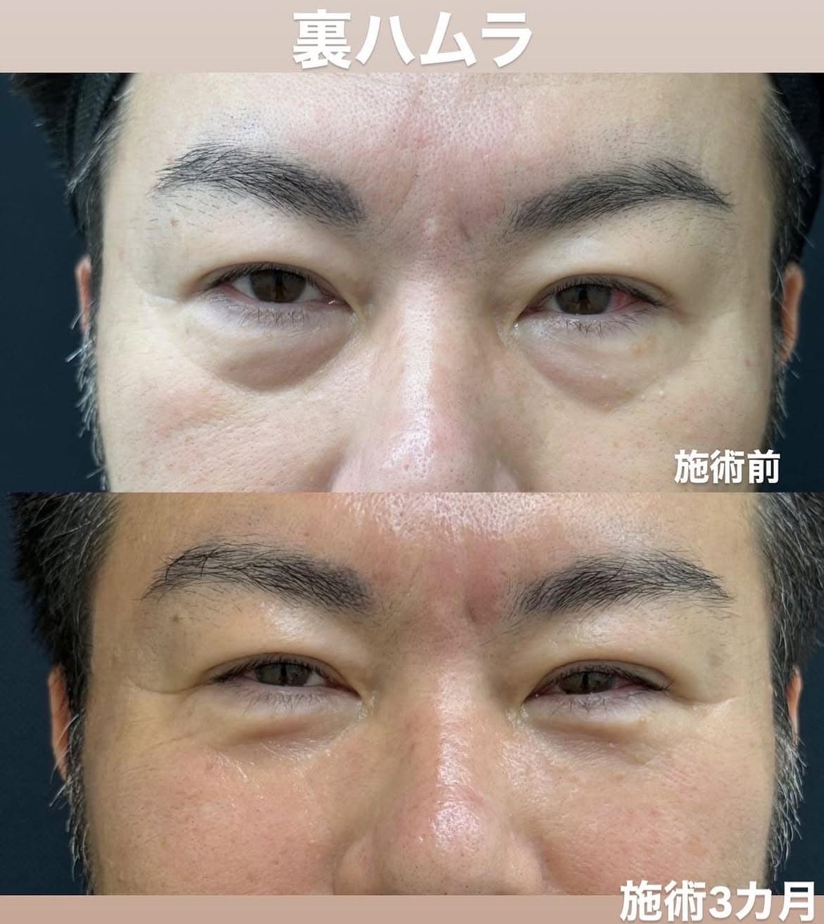 男性のクマ取り（裏ハムラ法）症例のメイン画像