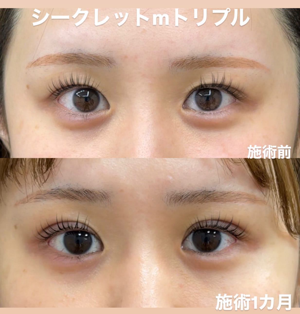 二重整形埋没法 シークレットmトリプルの症例のメイン画像