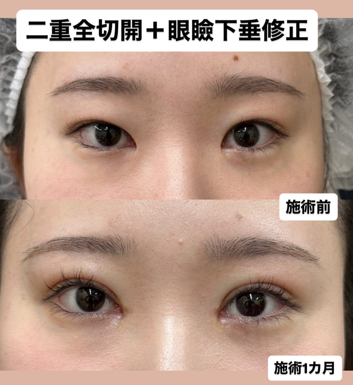 全切開＋目頭切開修正のメイン画像
