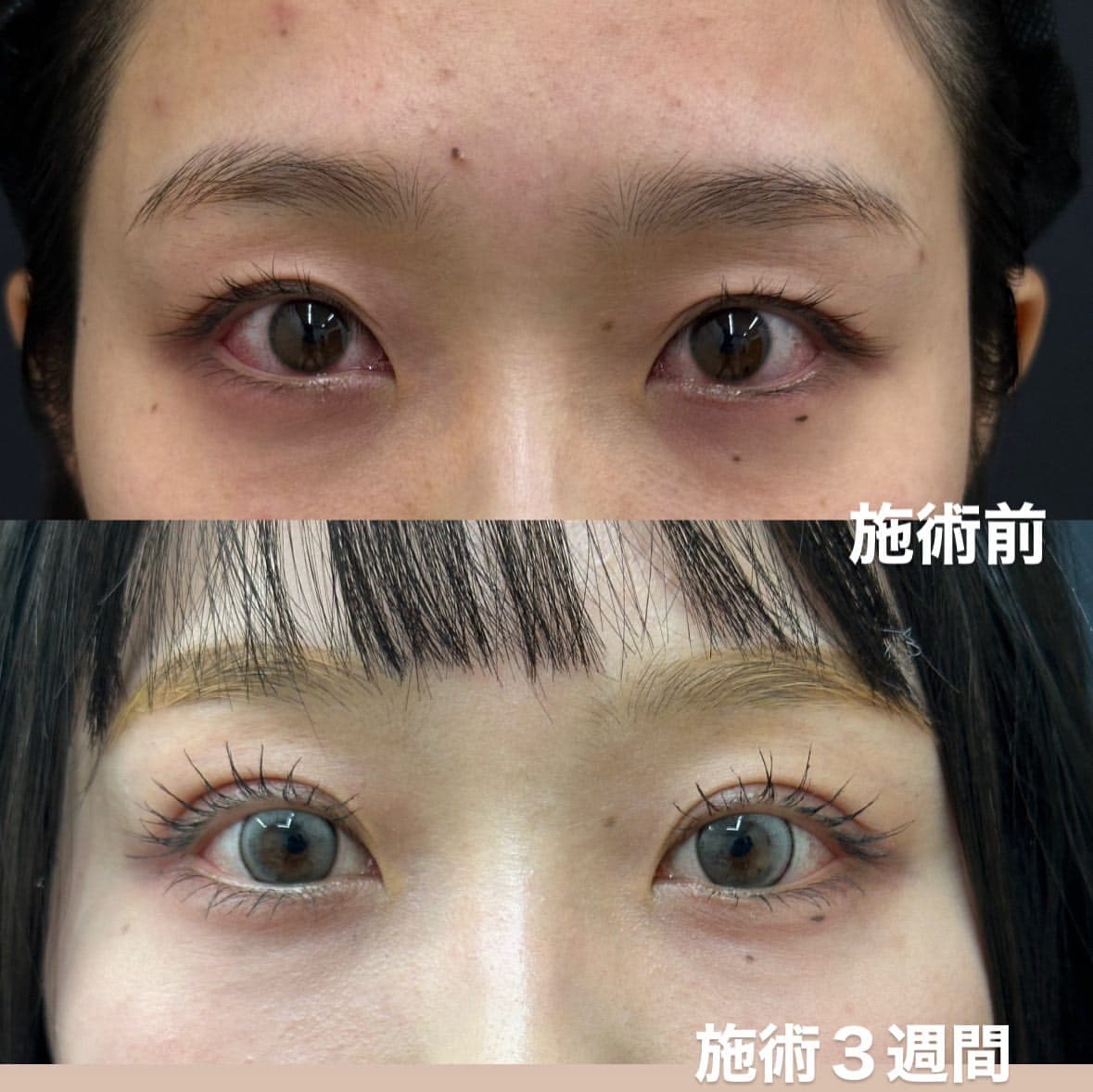 広島県で選ばれ続ける二重整形埋没法のメイン画像