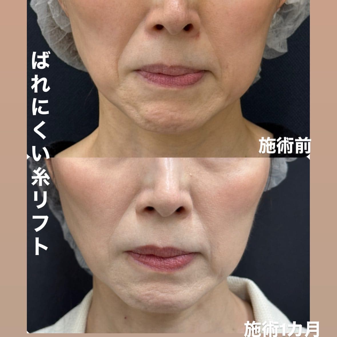 糸リフトで口周りがすっきりのメイン画像