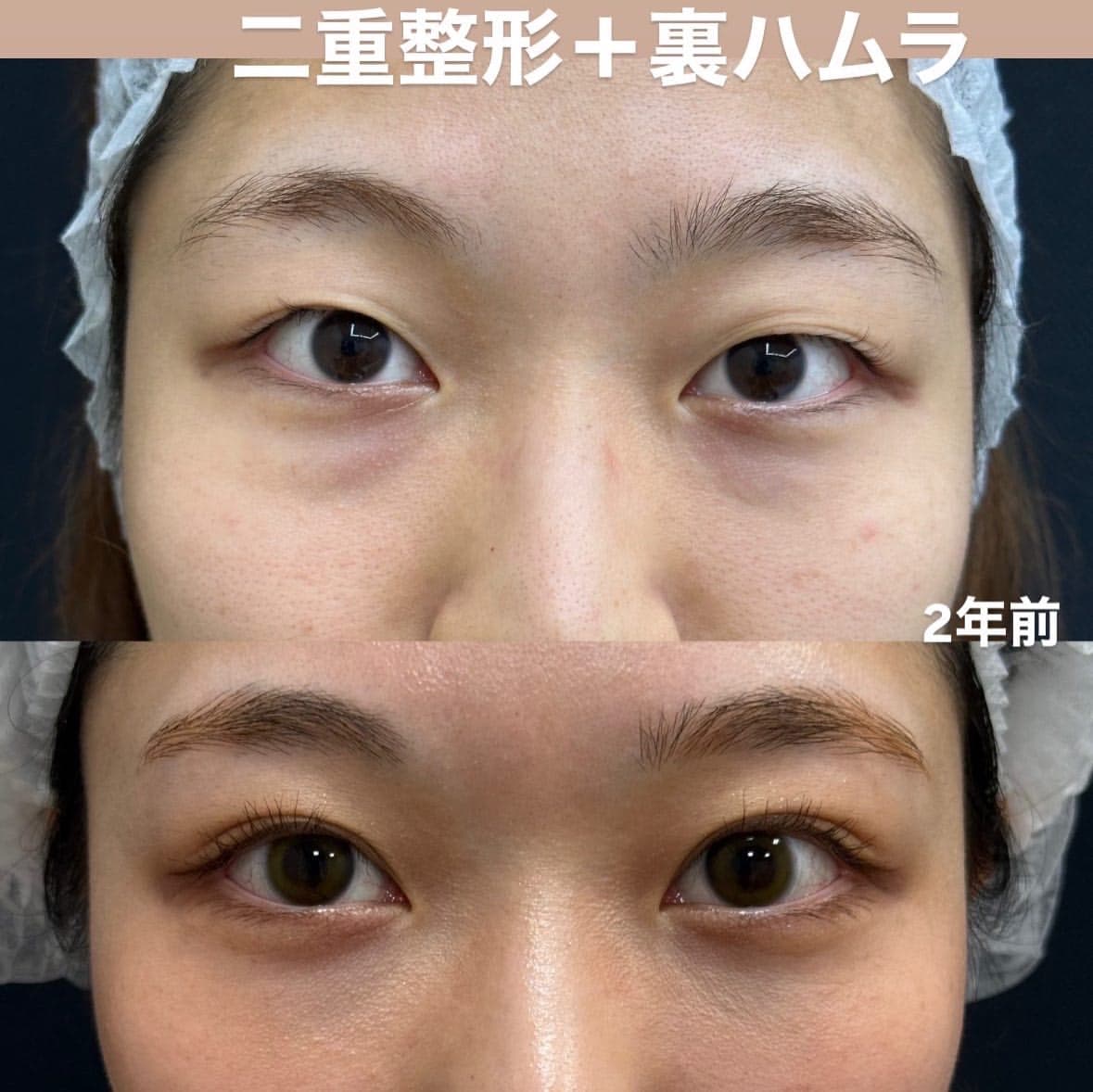 人気の複合治療の裏ハムラ＋二重整形埋没法のメイン画像