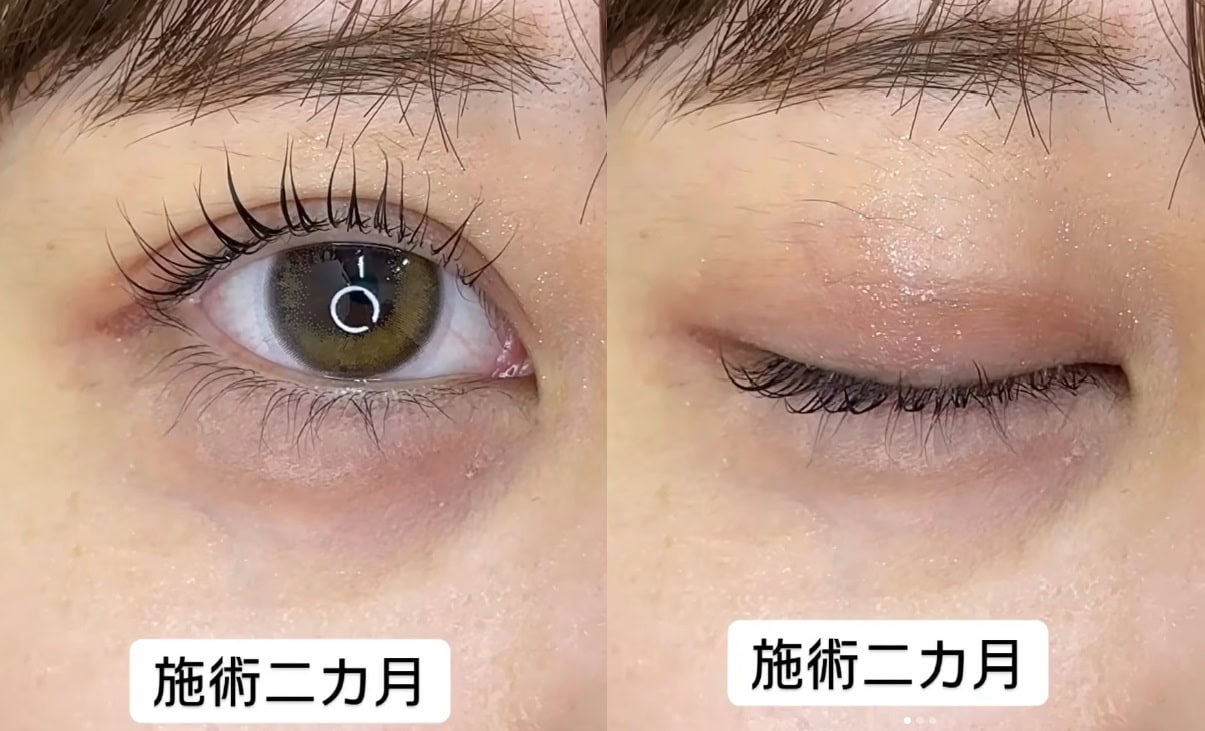 二重整形埋没法 症例_施術2カ月のメイン画像