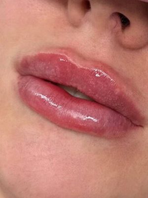 Fillers Lepper 4 - korpeveien legeklinikk fillers lepper