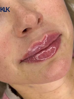 Fillers Lepper 3 - korpeveien legeklinikk fillers lepper resultat