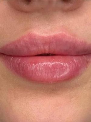 Fillers Lepper 2 - korpeveien legeklinikk lepper behandling resultat