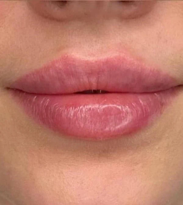 lepper behandling resultat