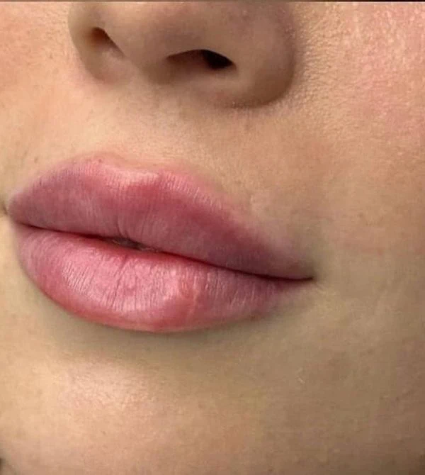 lepper fillers resultat