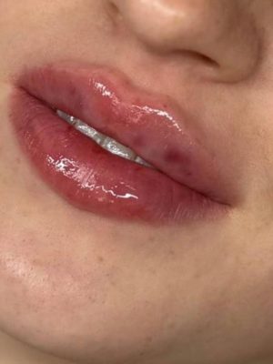 Fillers Lepper 5 - korpeveien legeklinikk resultar av lepper behandling