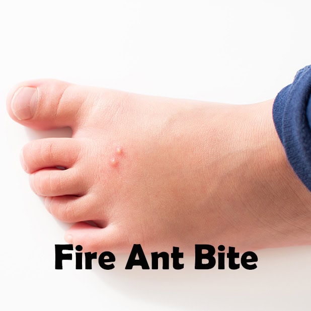 Foot with a small fire ant bite - Lawn Panther Landscaping, Turf & Weed Control - Fuquay-Varina