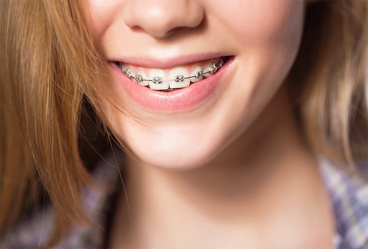 Traditional Braces