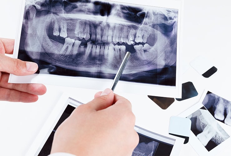 Teeth Extraction