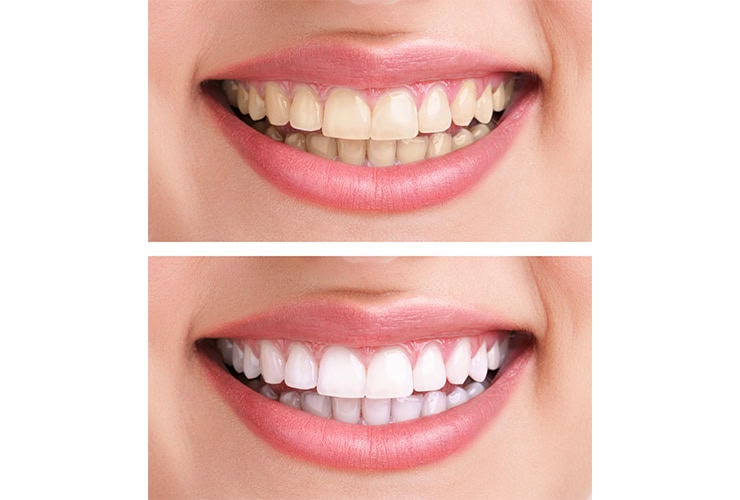 Teeth Whitening