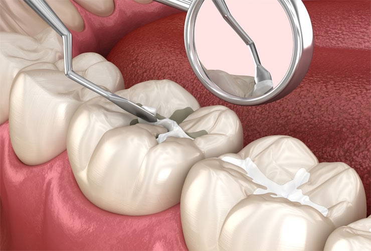 Fissure Sealants