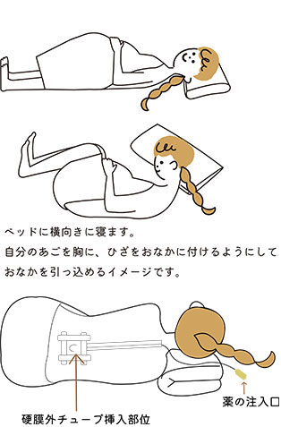 無痛分娩の方法2