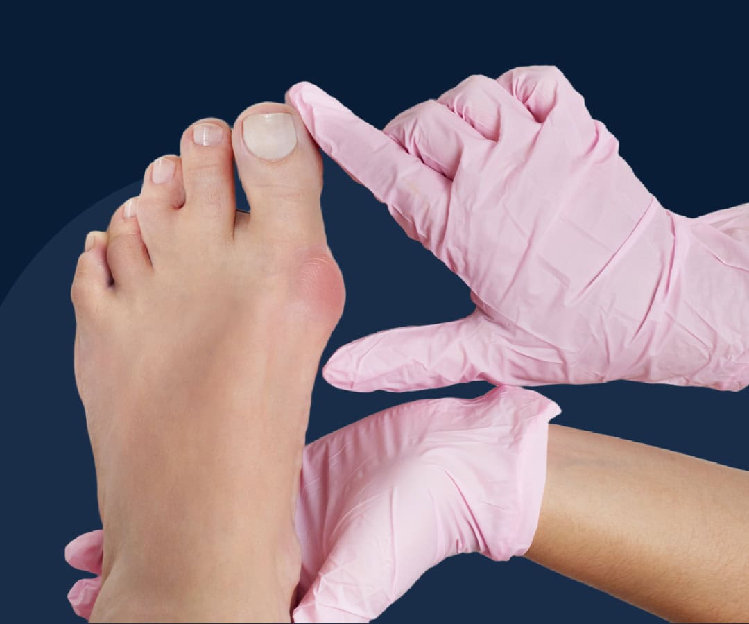 Bunion Treatment Aberdeen, NJ