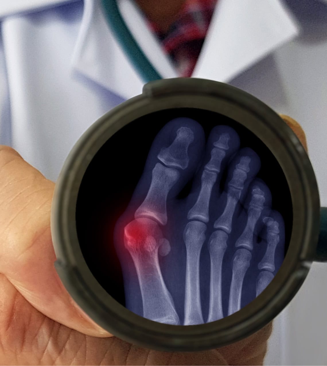 Bunion Correction Aberdeen, NJ